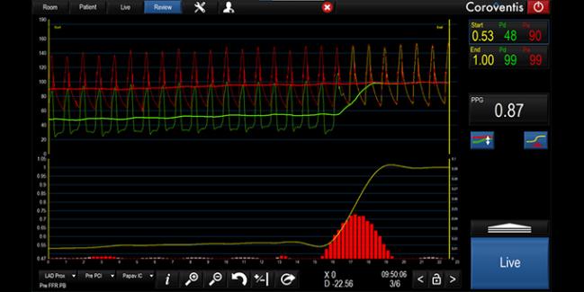 FFR Pullback Measure Linked to Likelihood of Angina Relief After PCI